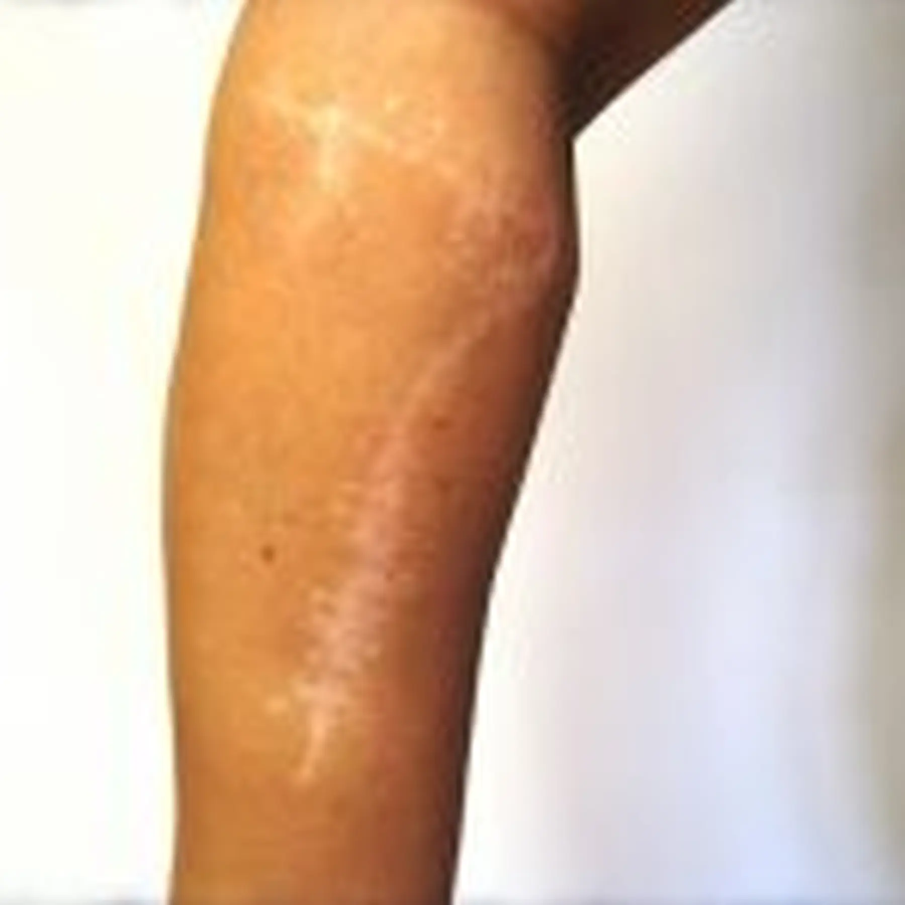 Ingesś Tattoo&Piercing Stübchen Narbe am Arm